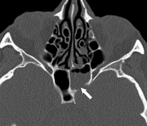 ct scan for csf leaks